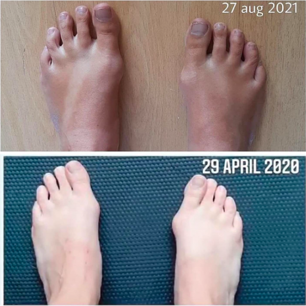 transformacion del pie
